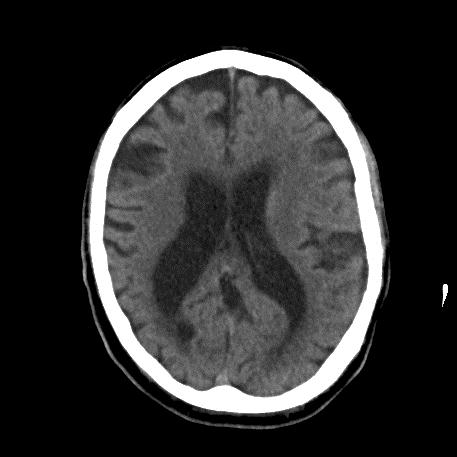 Dementa CT Scan