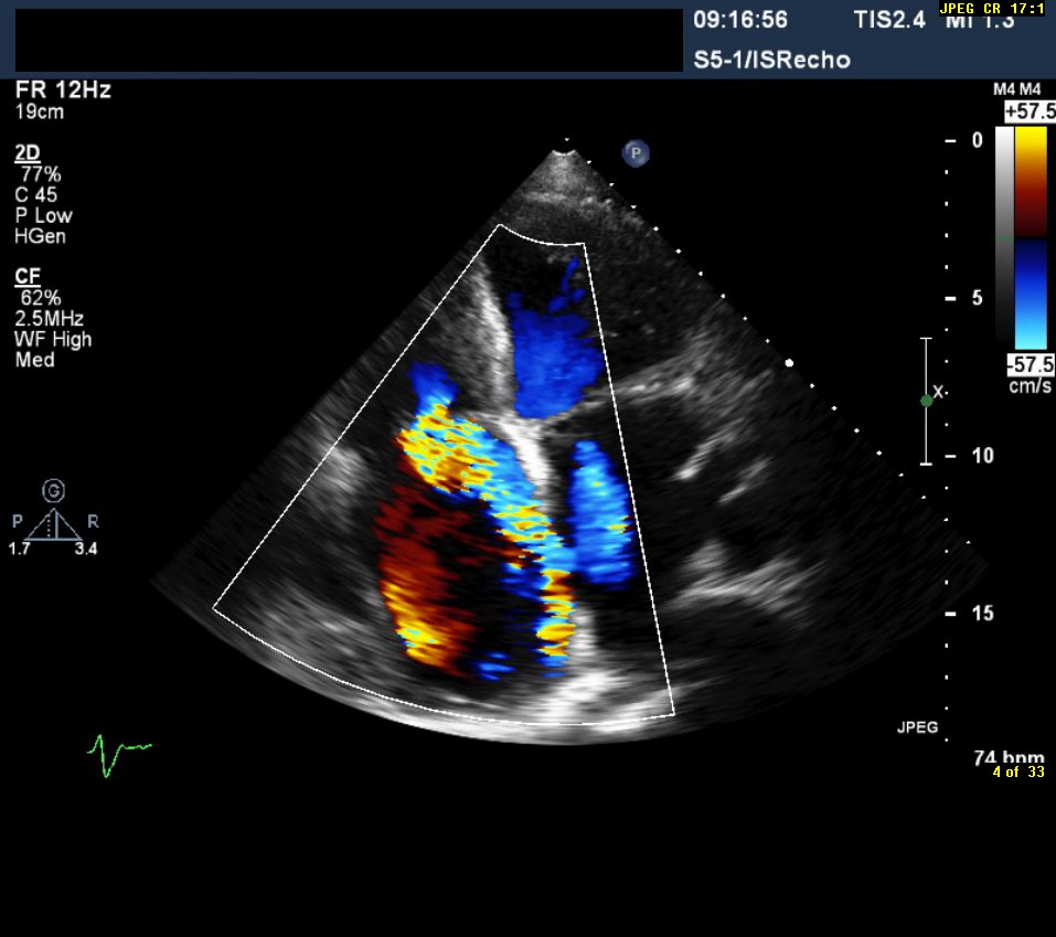 echocardiogram