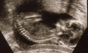 ultrasound of pregnancy