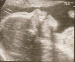 Fetal ultrasound