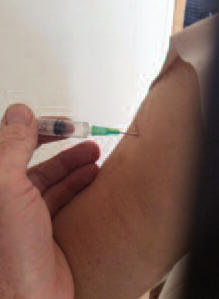 injection