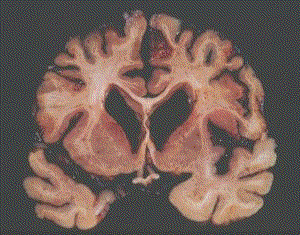 Slice of Tont Bland's Brain