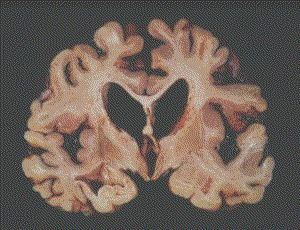 Slice of Tony Bland's brain